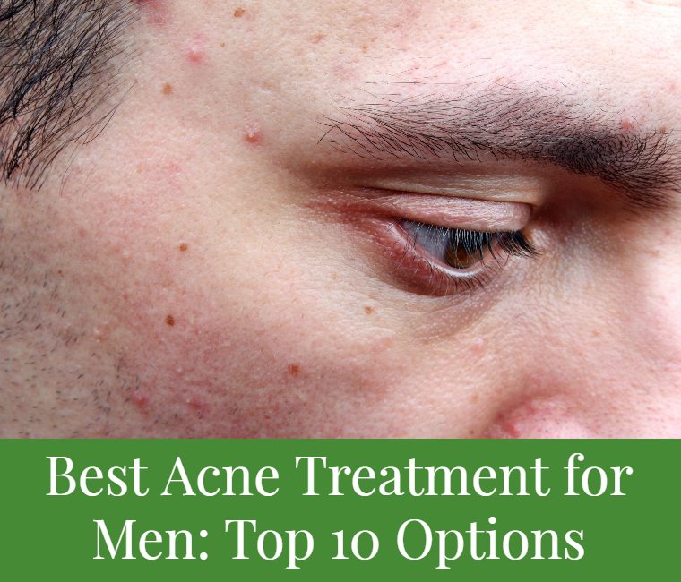 Best Acne Treatment for Men: Top 10 Options - Cushy Spa