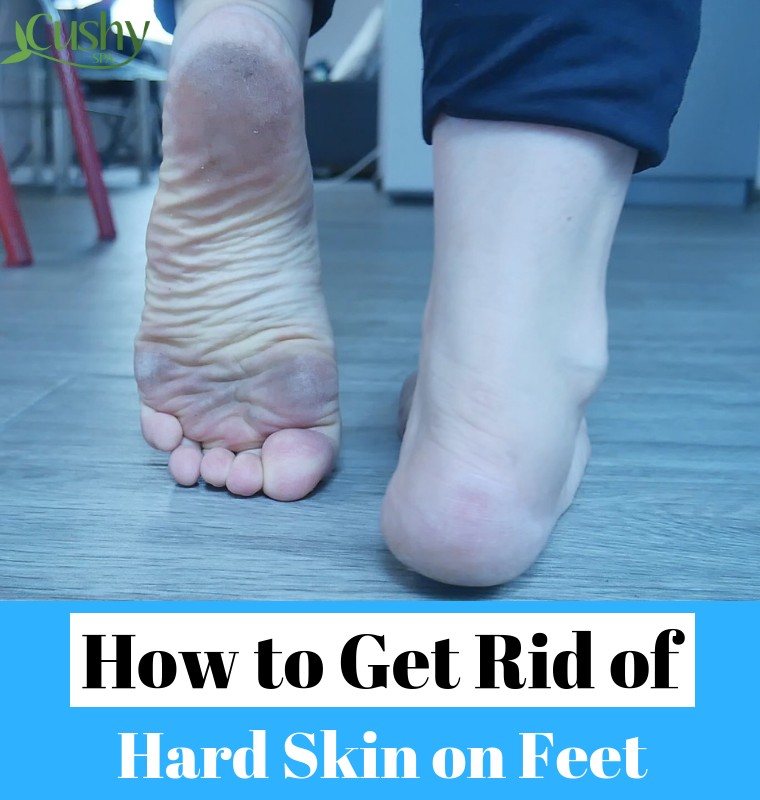 best way to remove dead skin from feet